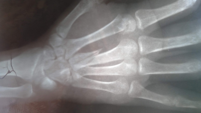 Botbreuken door gladheid; drukte bij Spoedeisende Hulp Noordwest Ziekenhuis